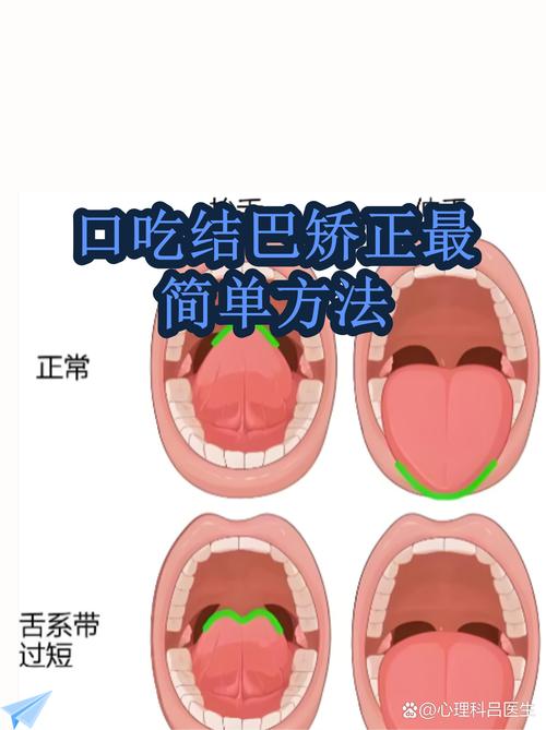 口吃结巴矫正最简单方法